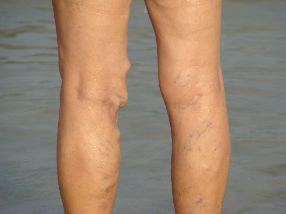 varicose veins