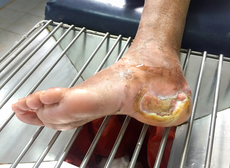Diabetes foot
