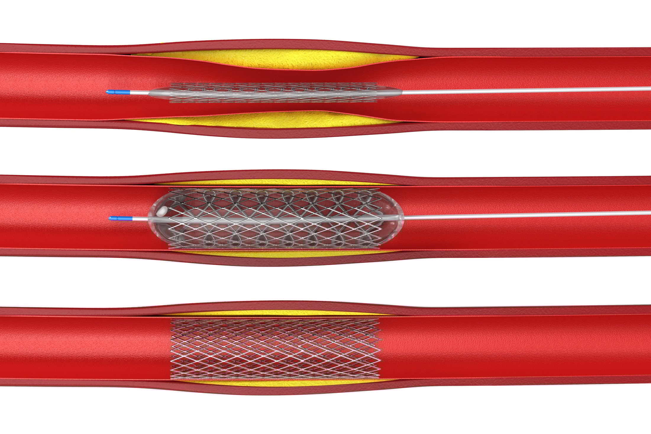 Balloon Angioplasty Procedure