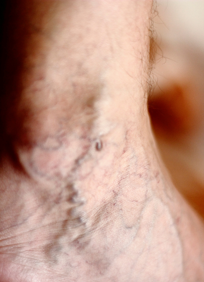 Varicosity, Varicose Vein