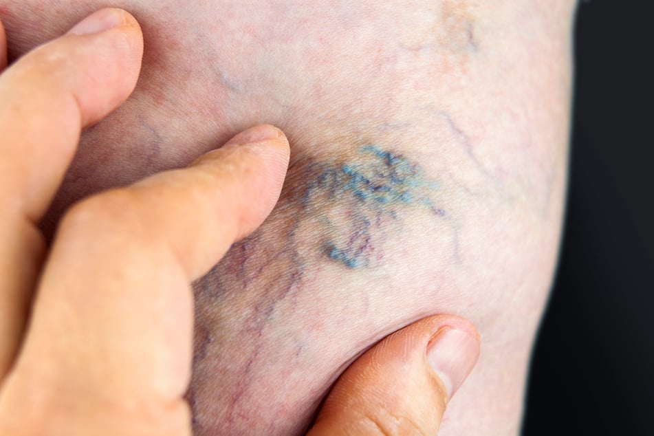 Varicose vein