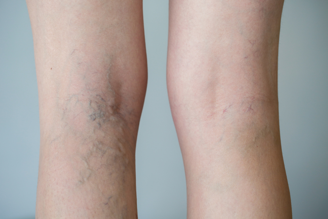 Varicose veins