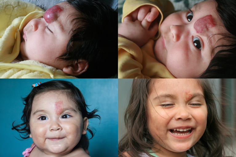 Infantile hemangioma