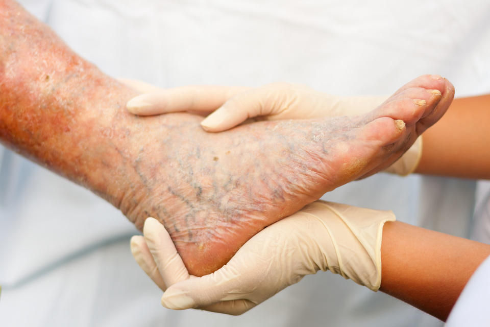 Varicose veins