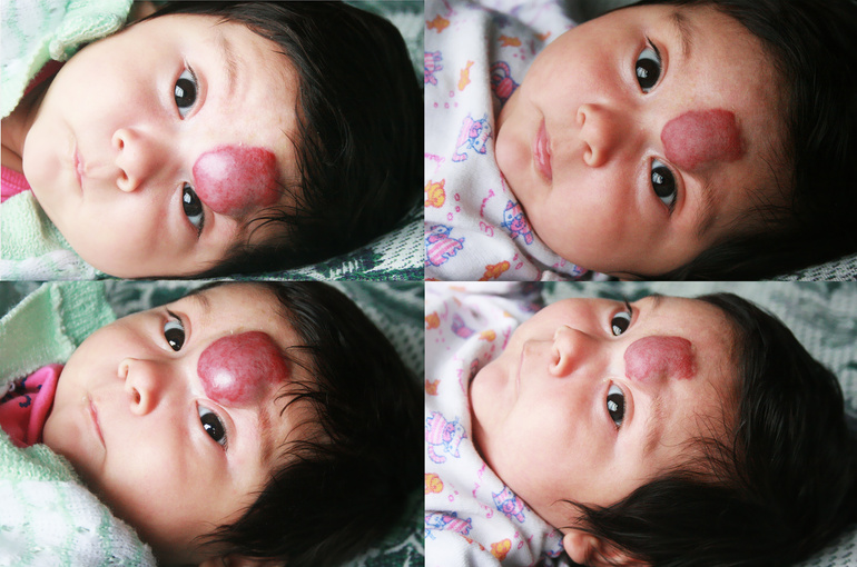 Infantile hemangioma