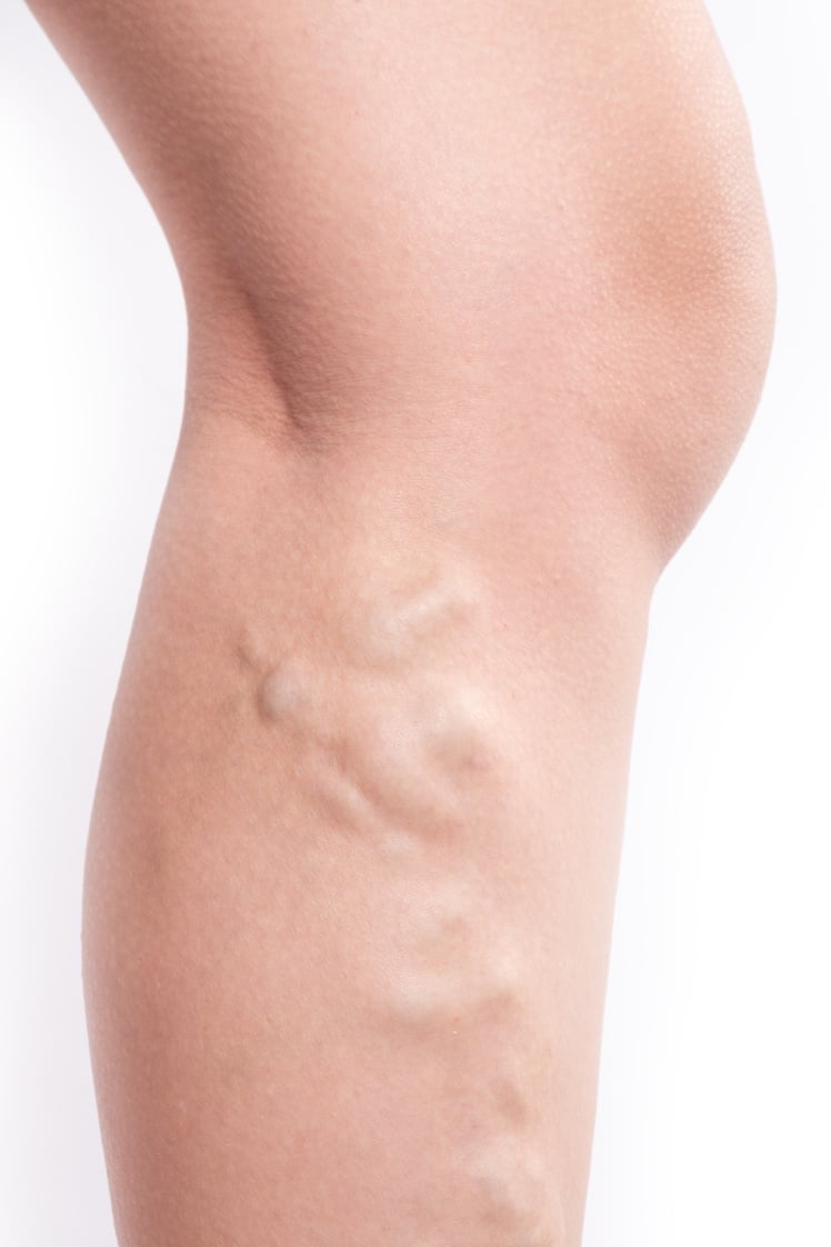 Varicose Veins in a Person's Leg