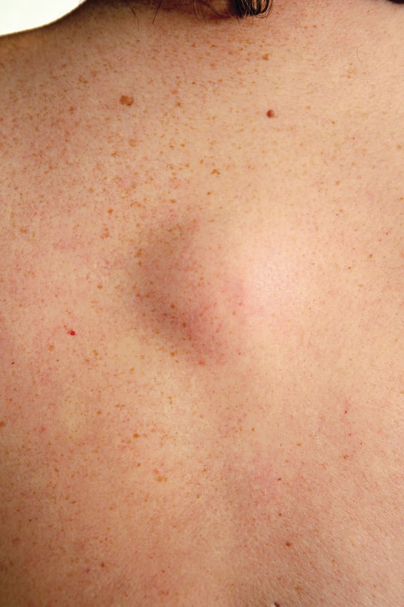Lipoma Tumor