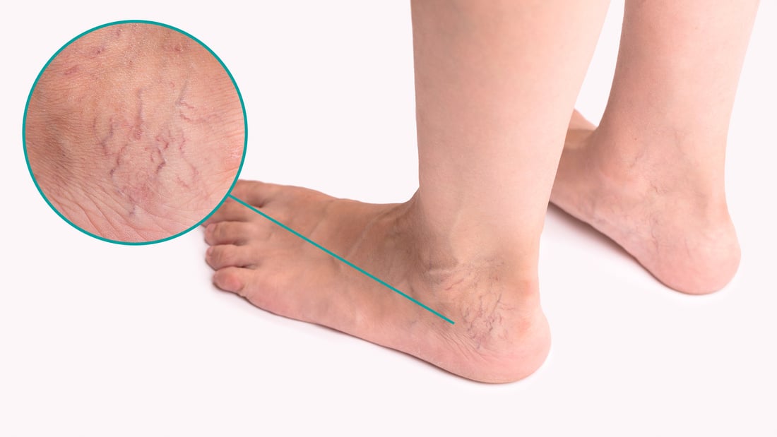 Varicose veins closeup.