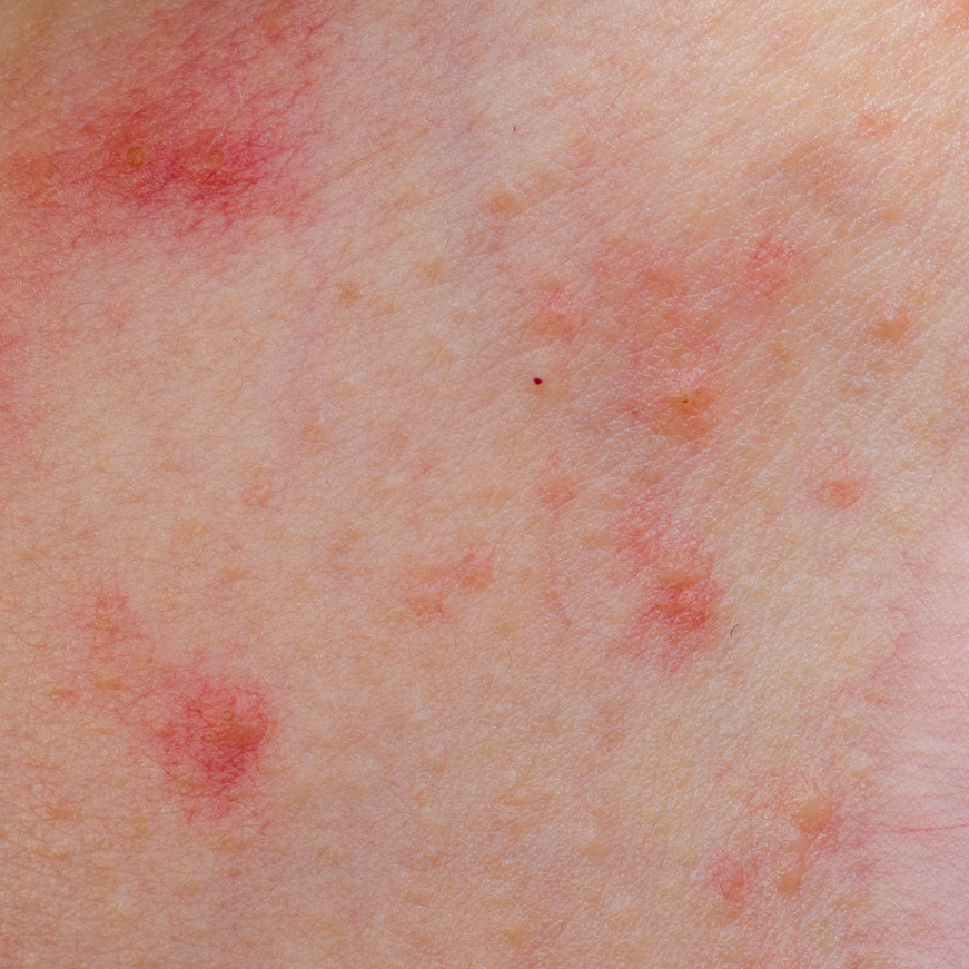 Allergic Rash Dermatitis Eczema 
