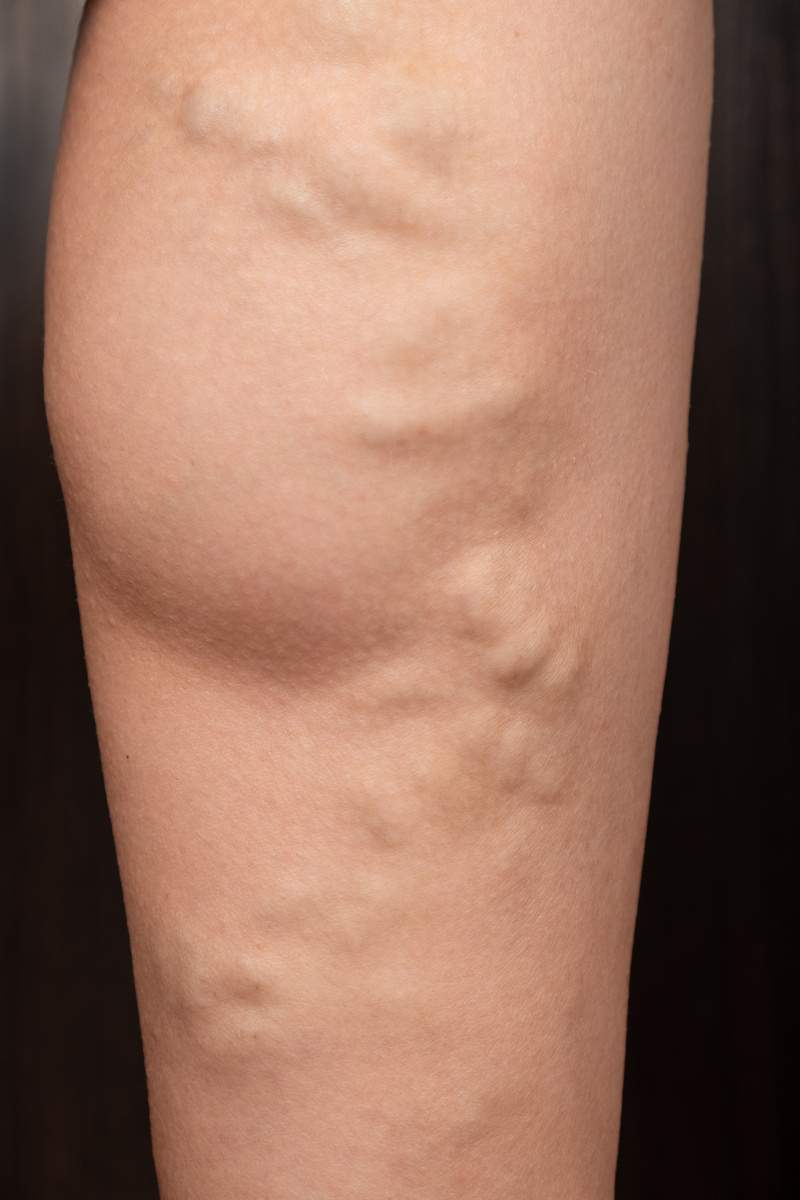 Varicose Veins in Leg
