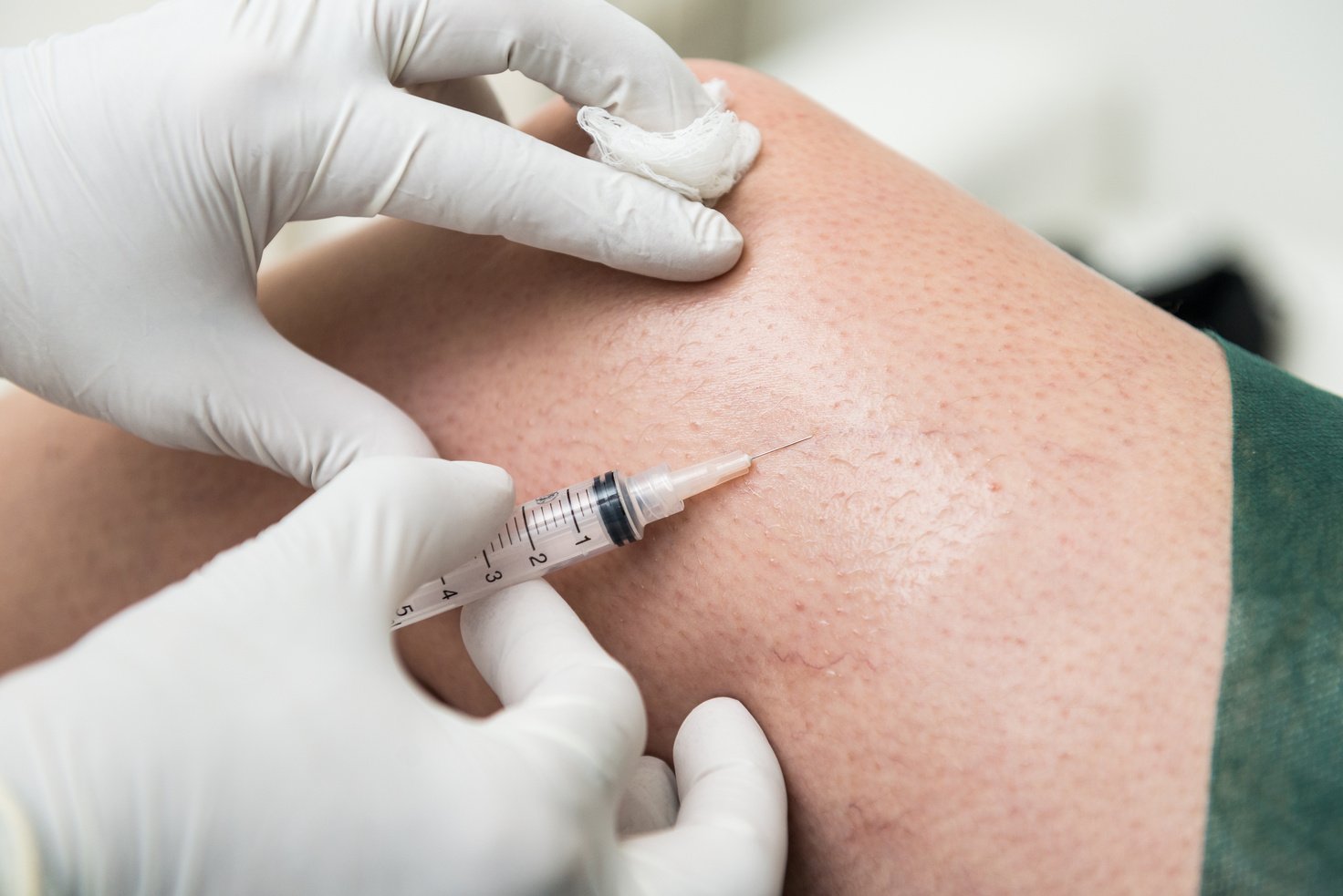 Sclerotherapy, treatment to remove microvarices