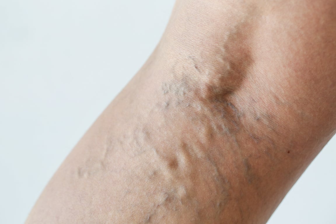 Varicose veins