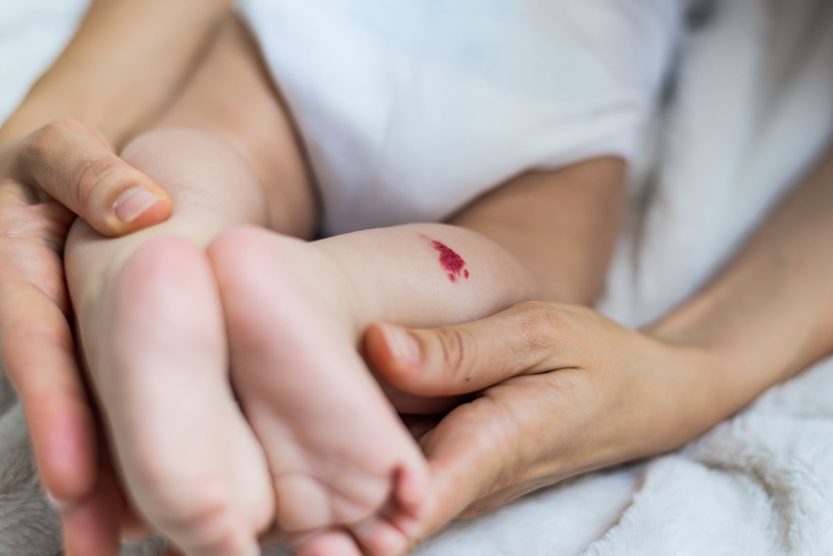 Capillary hemangioma red birthmark on the baby's leg