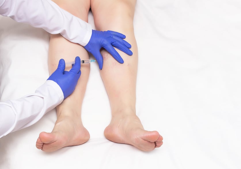 The Doctor Makes an Injection of Sclerotherapy to the Patient Who Has Varicose Veins in the Legs, Miniphlebectomy, Copy Space