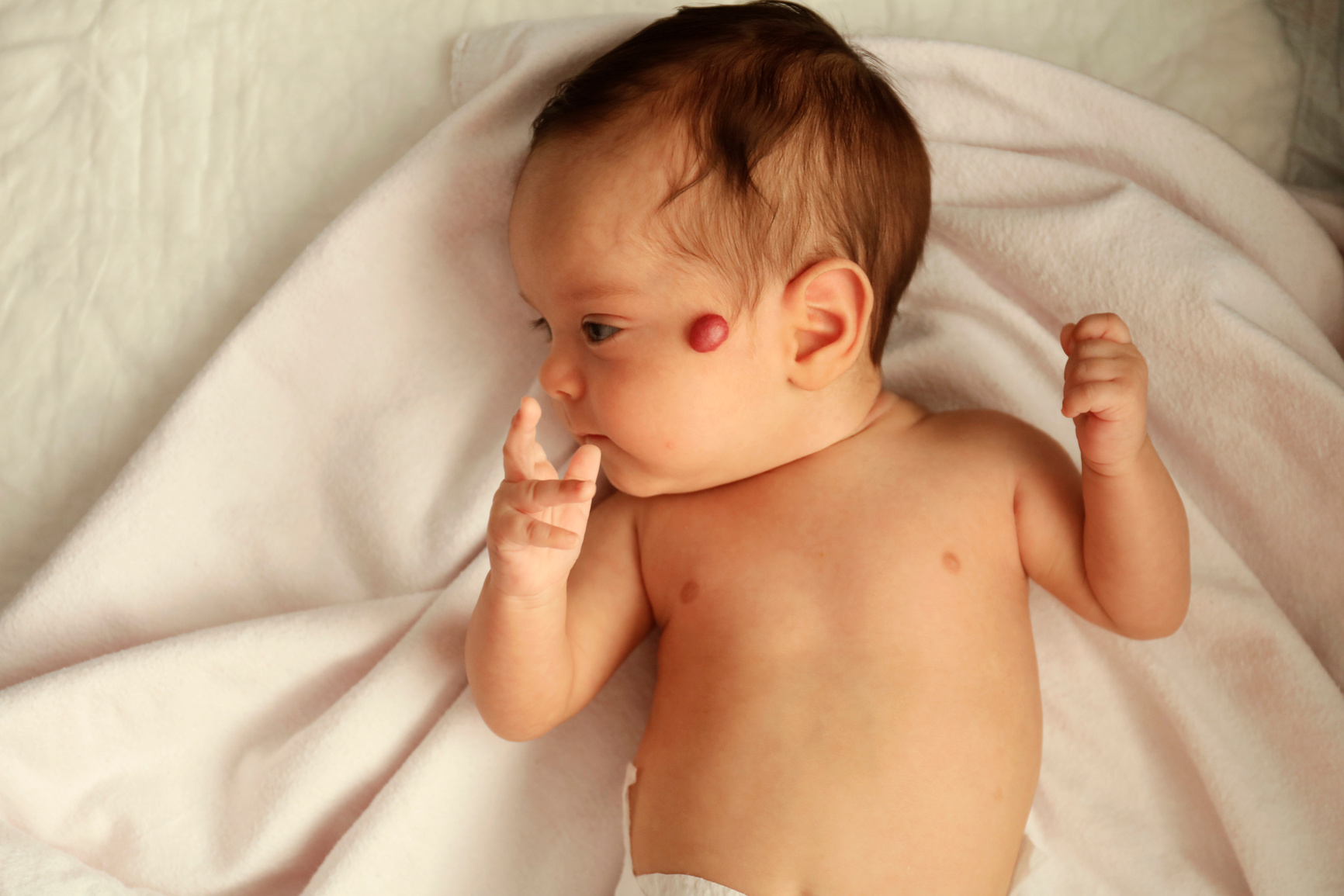 Hemangioma on the face of a baby