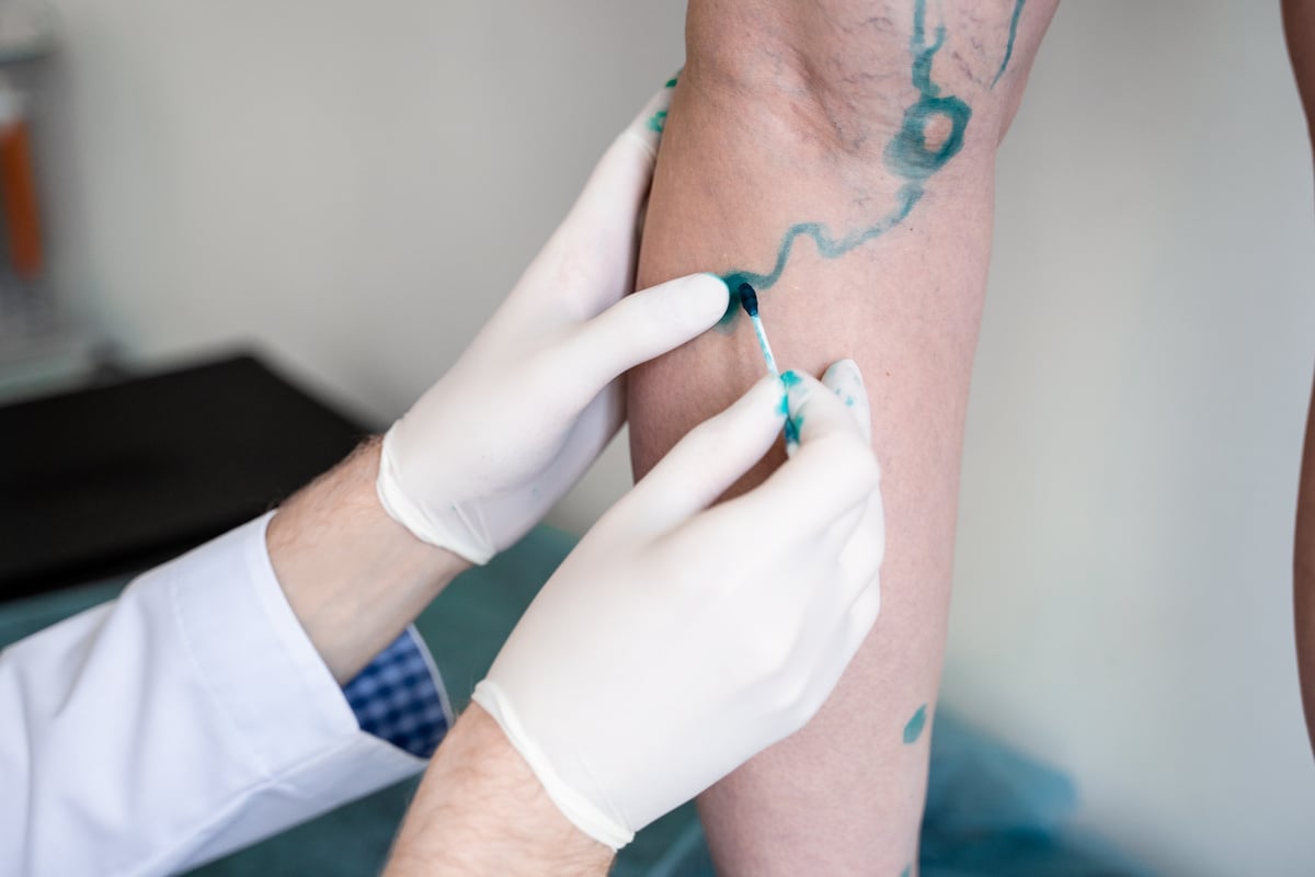 Vein markup. Vascular surgeon is marking veins for varicose surgery
