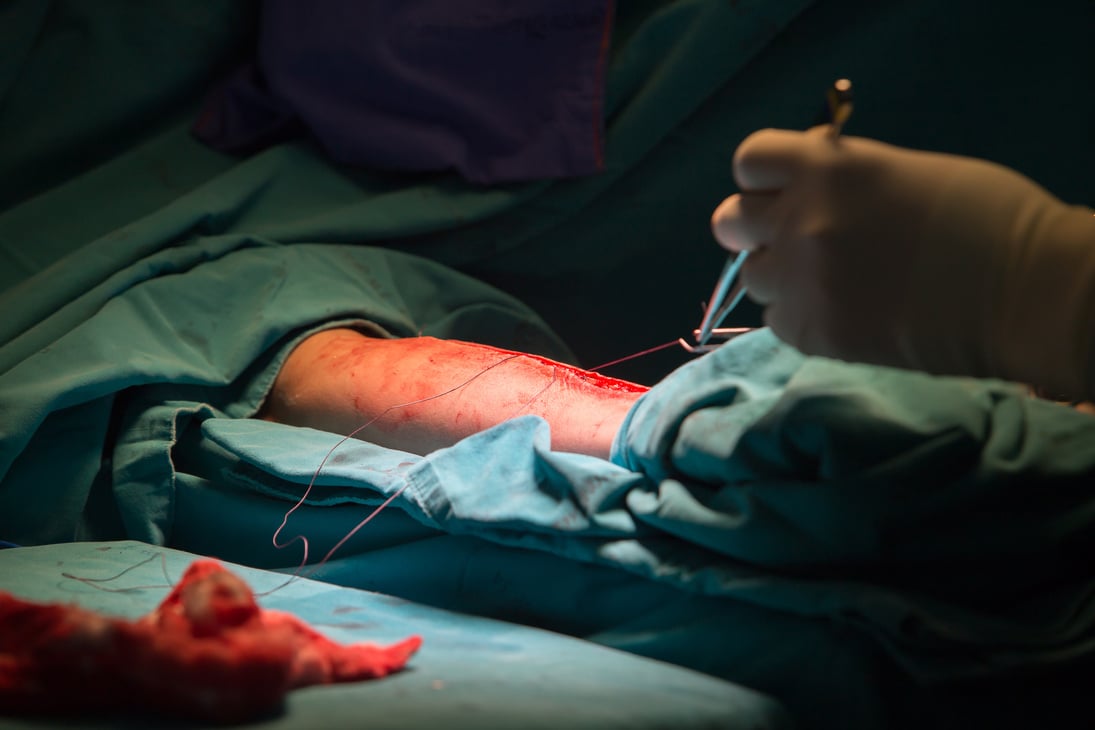 Surgery for Coronary Artery Bypass Grafting: CABG