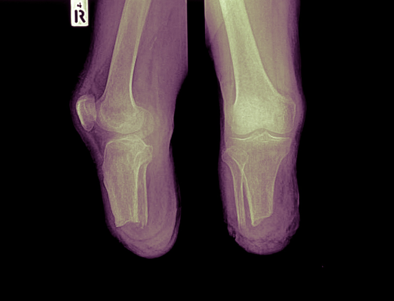 Below knee amputation stump.