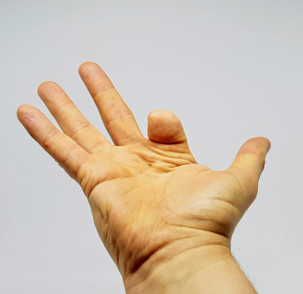 Partial amputation to finger.